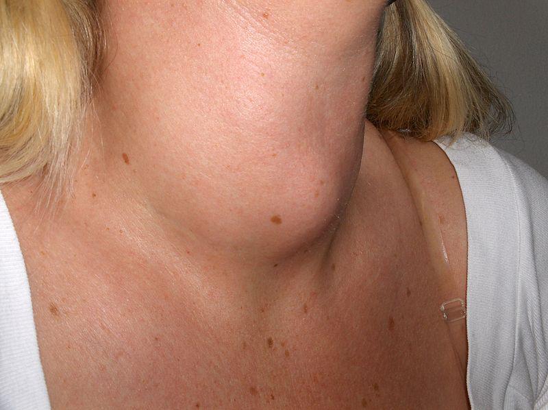 Bulge in woman's neck