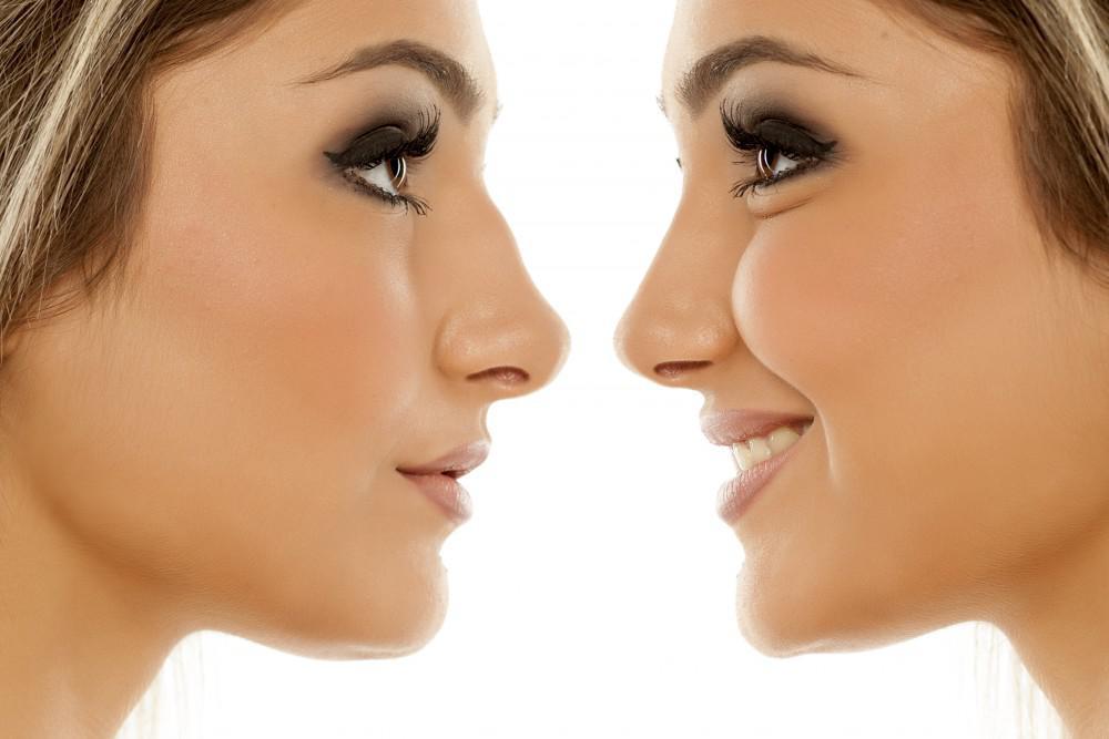 Side Effects & Risks of Nose Augmentation Surgery