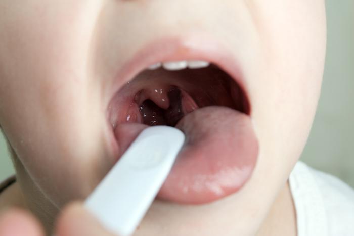 Should My Child Have Their Tonsils Removed?
