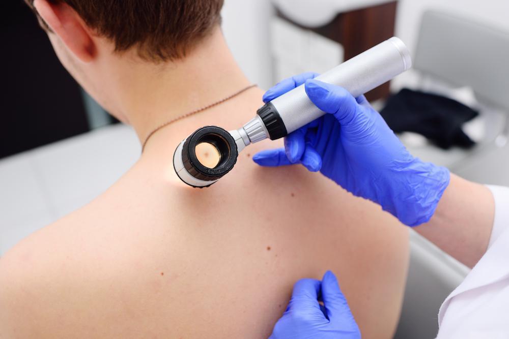 Staying Healthy With Skin Cancer Checks