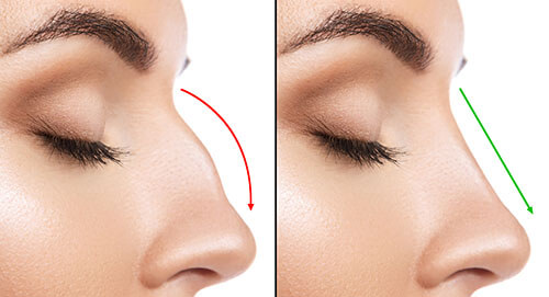 Chart Illustrating a Before and After Nose Surgery