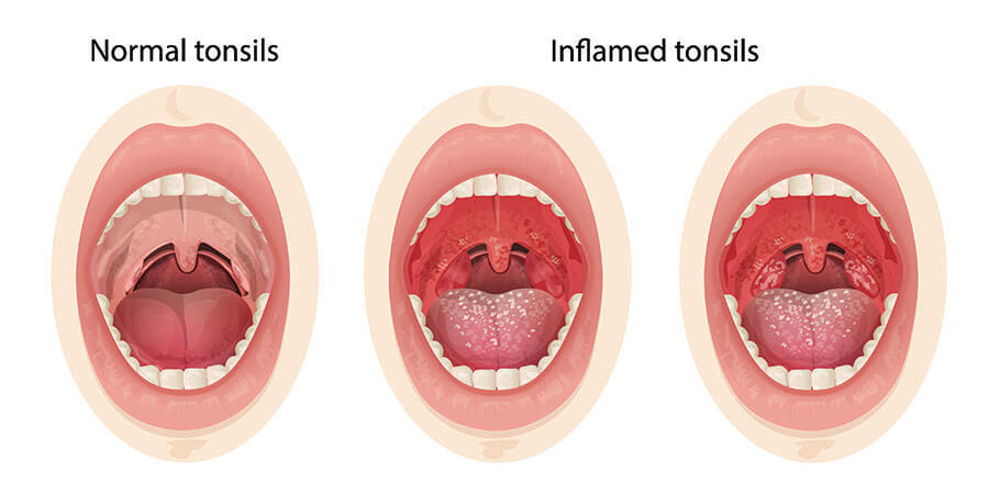 Chart Illustrating Normal Tonsils Compared With Inflamed Tonsils